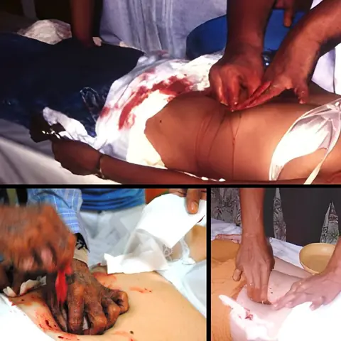 Psyhic Surgery الجراحة الروحانية